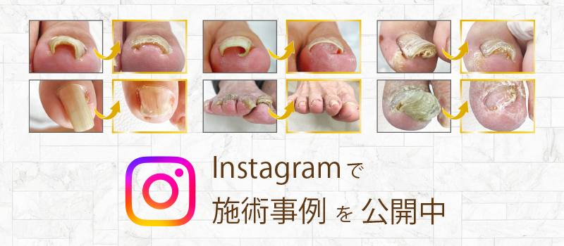 福井市巻き爪センターのinstagram